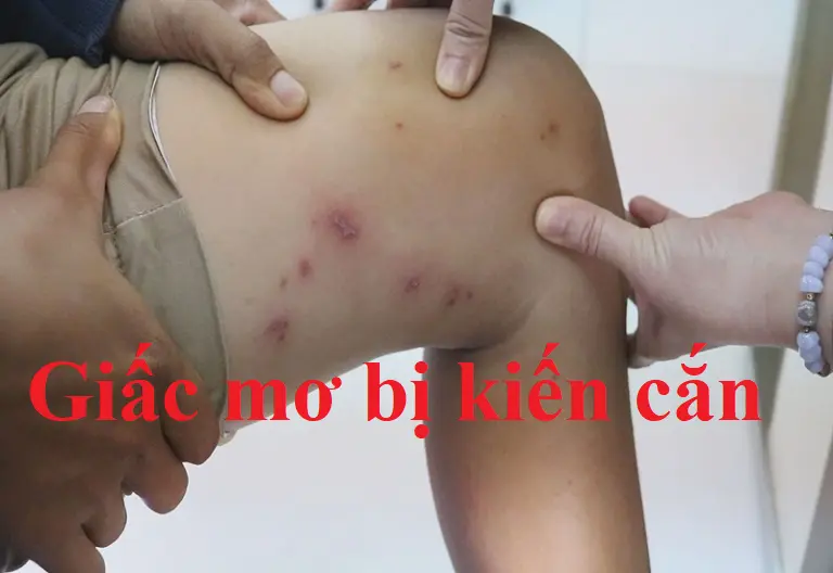 Nằm mơ thấy kiến ​​lửa cắn  